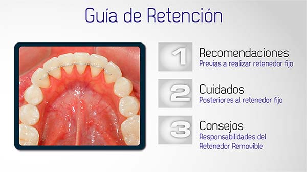Guía Retenedores Fijos y Removibles