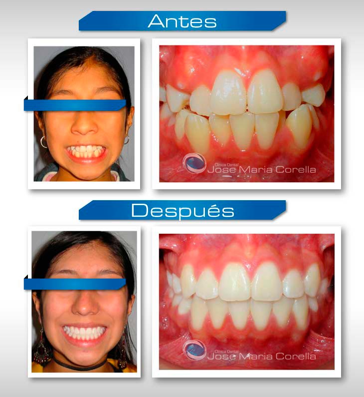 Caso clínico 1 - Diseño de sonrisa
