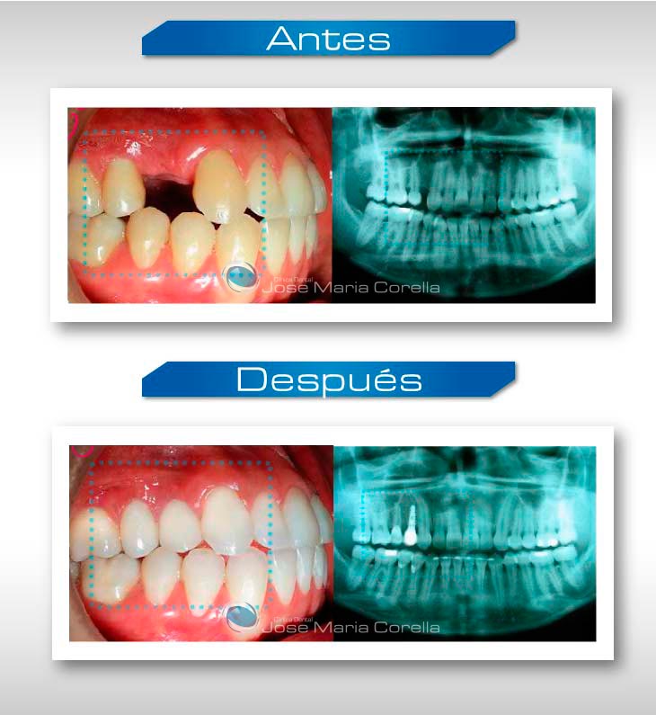 Caso clínico 1 - Implantología Oral