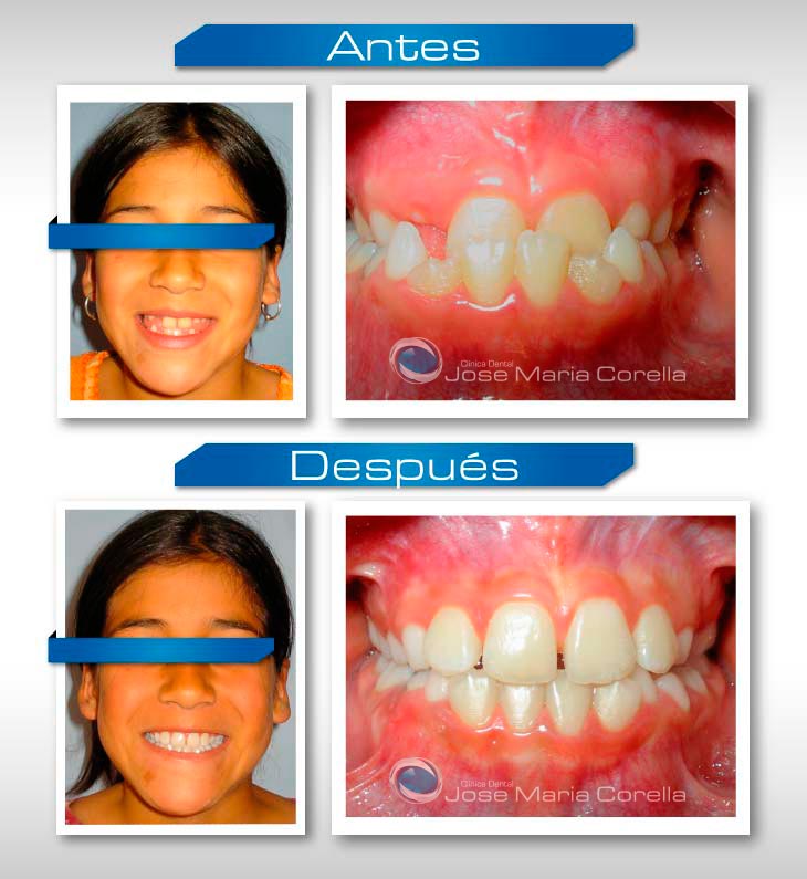 Caso clínico 1 - Ortopedia Dentomaxilar