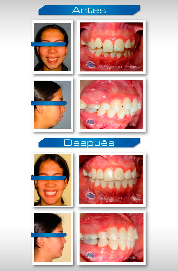 Caso clínico 1 - Ortodoncia Pre y Post Quirúrgica