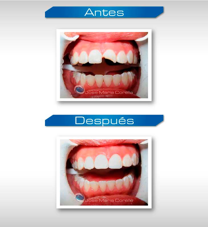 Caso clínico 1 - Reconstrucción Dental
