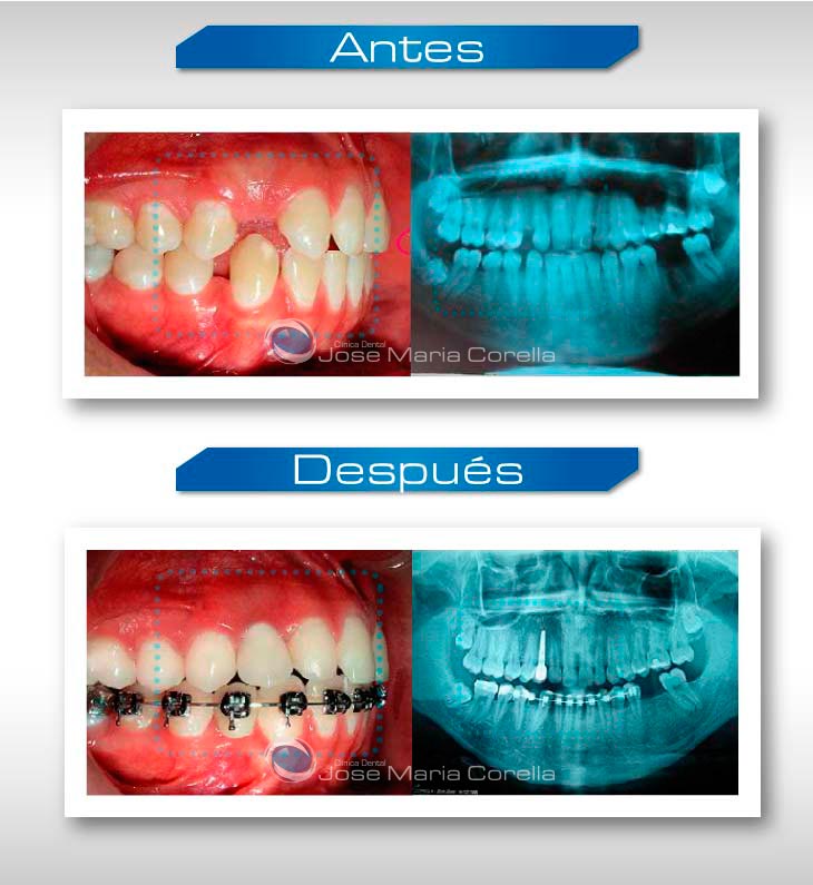 Caso clínico 2 - Implantología Oral