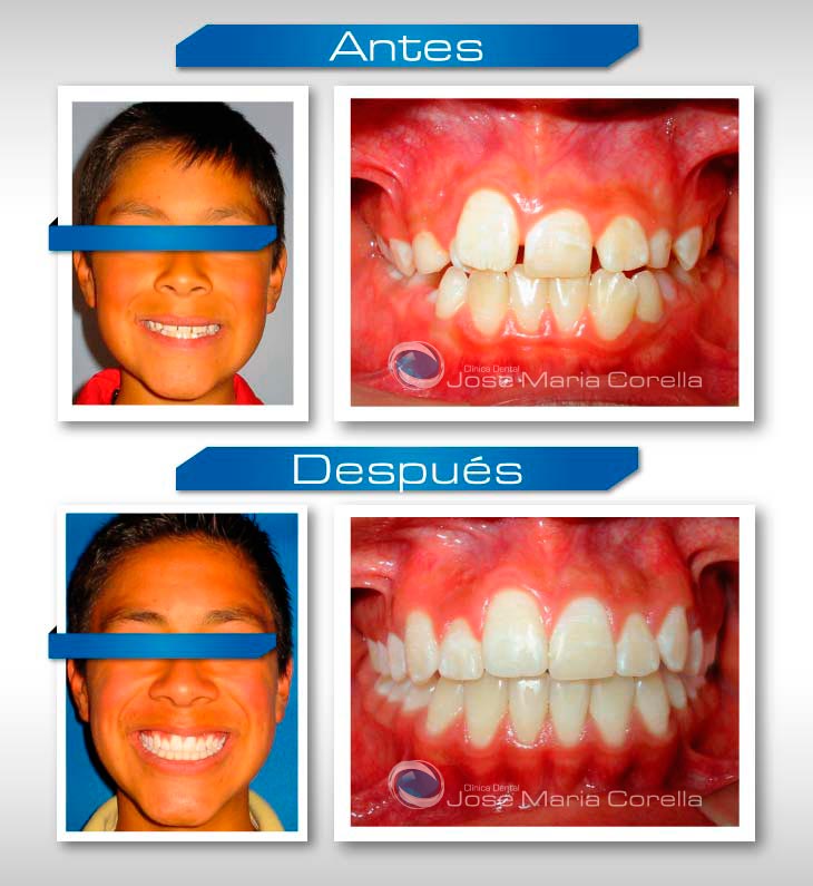 Caso clínico 2 - Ortopedia Dentomaxilar