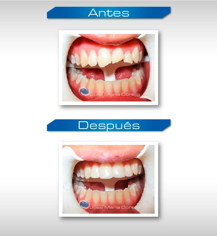 Caso clínico 2 - Reconstrucción Dental