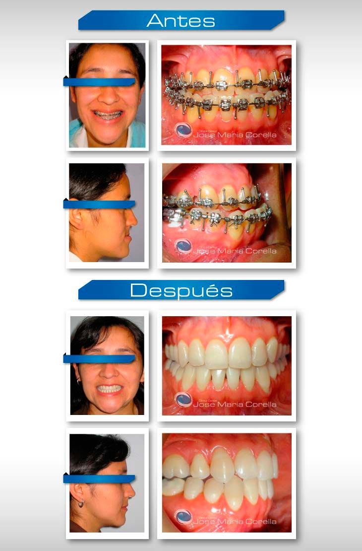 Caso clínico 2 - Ortodoncia Pre y Post Quirúrgica